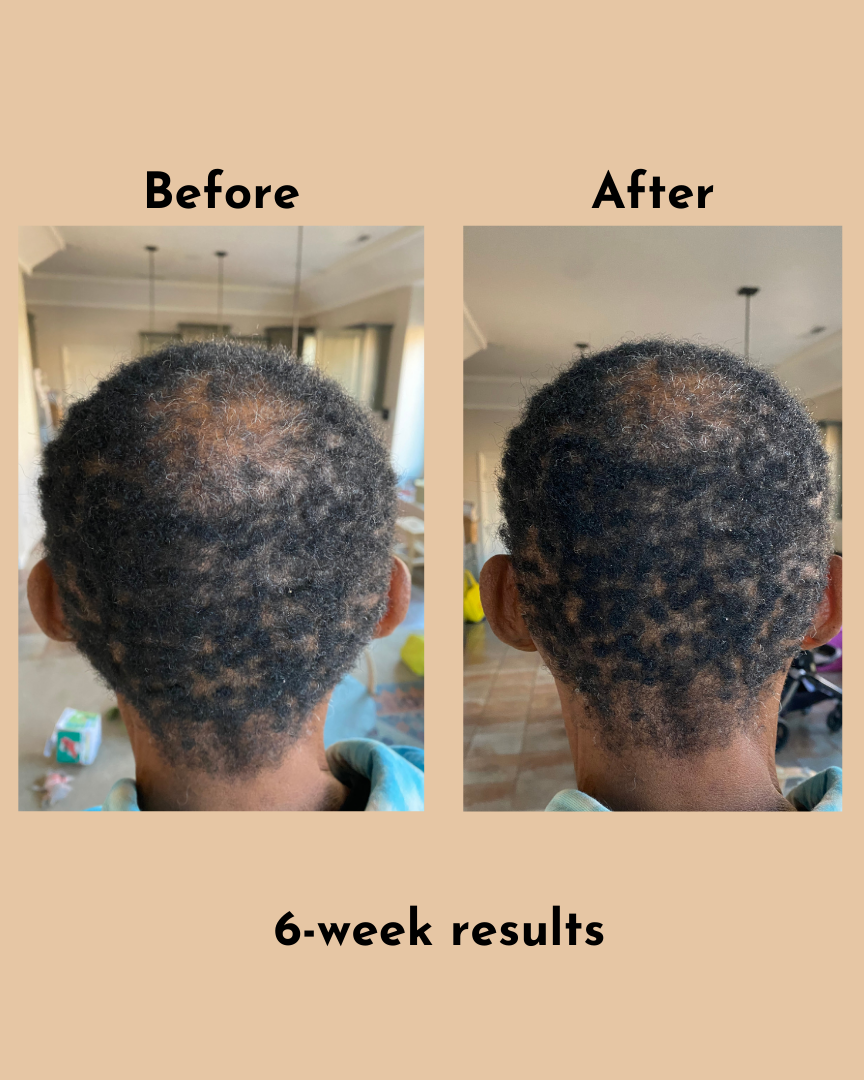 GoGrow Hair Elixir (6 Bottles)